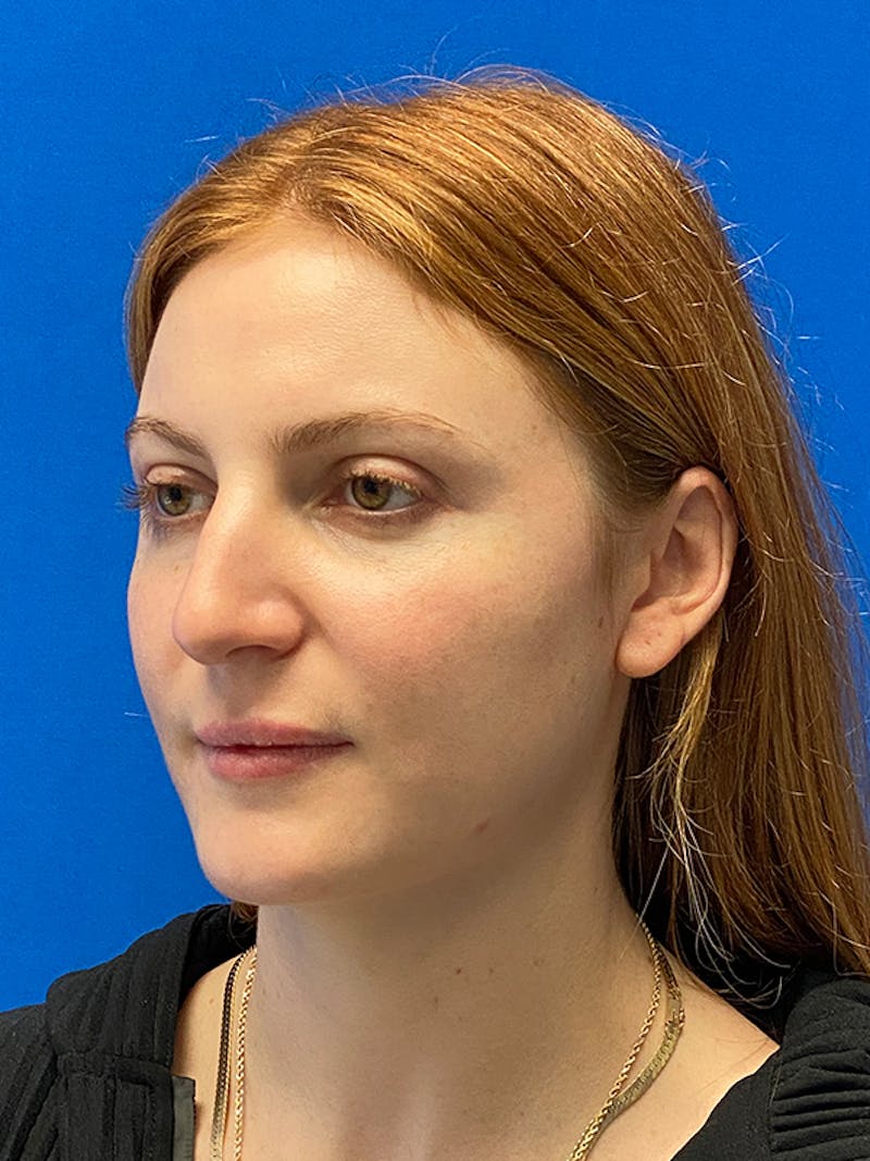 Primary Rhinoplasty Before & After Gallery - Patient 202446 - Image 7