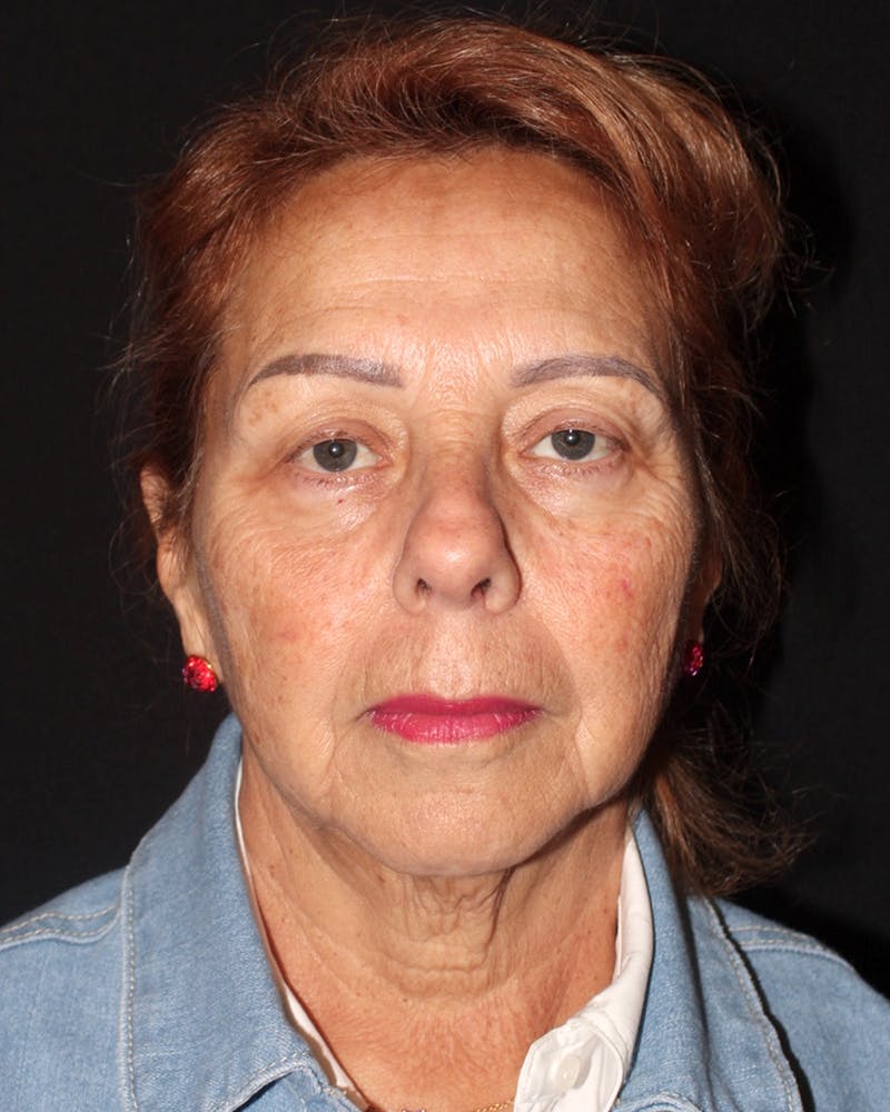 Facelift Before & After Gallery - Patient 304571 - Image 1