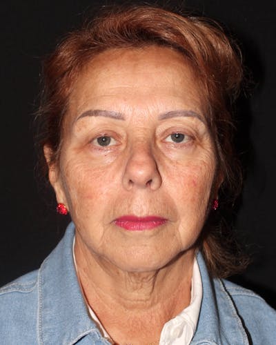Facelift Before & After Gallery - Patient 304571 - Image 1