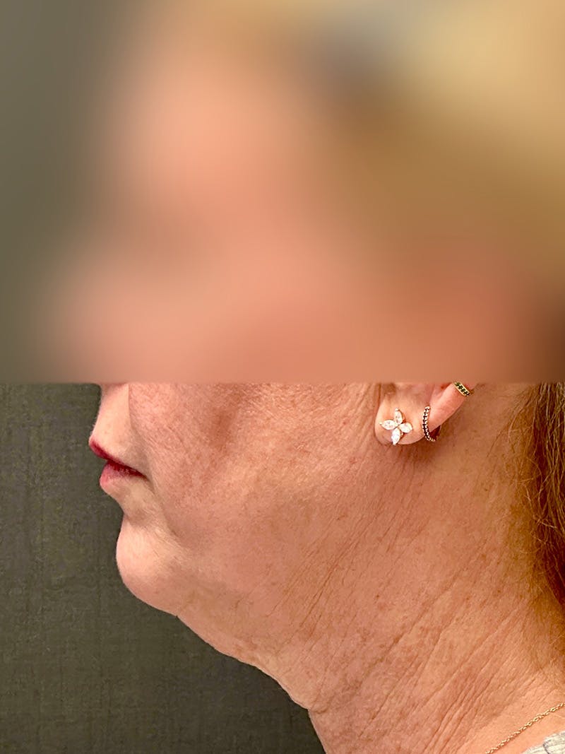 Facelift Before & After Gallery - Patient 355862 - Image 5