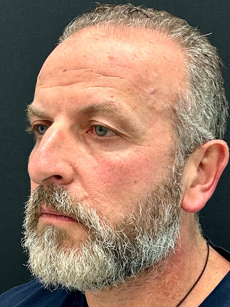 Blepharoplasty Before & After Gallery - Patient 669983 - Image 5