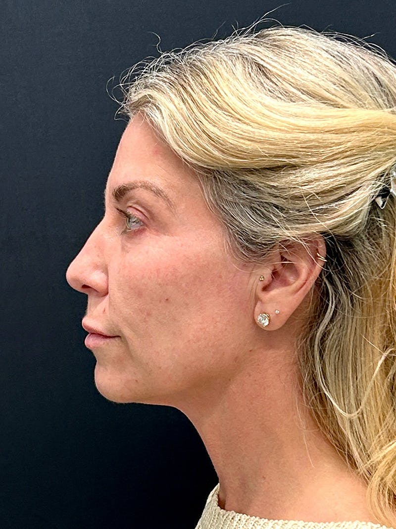 Facelift Before & After Gallery - Patient 420053 - Image 5