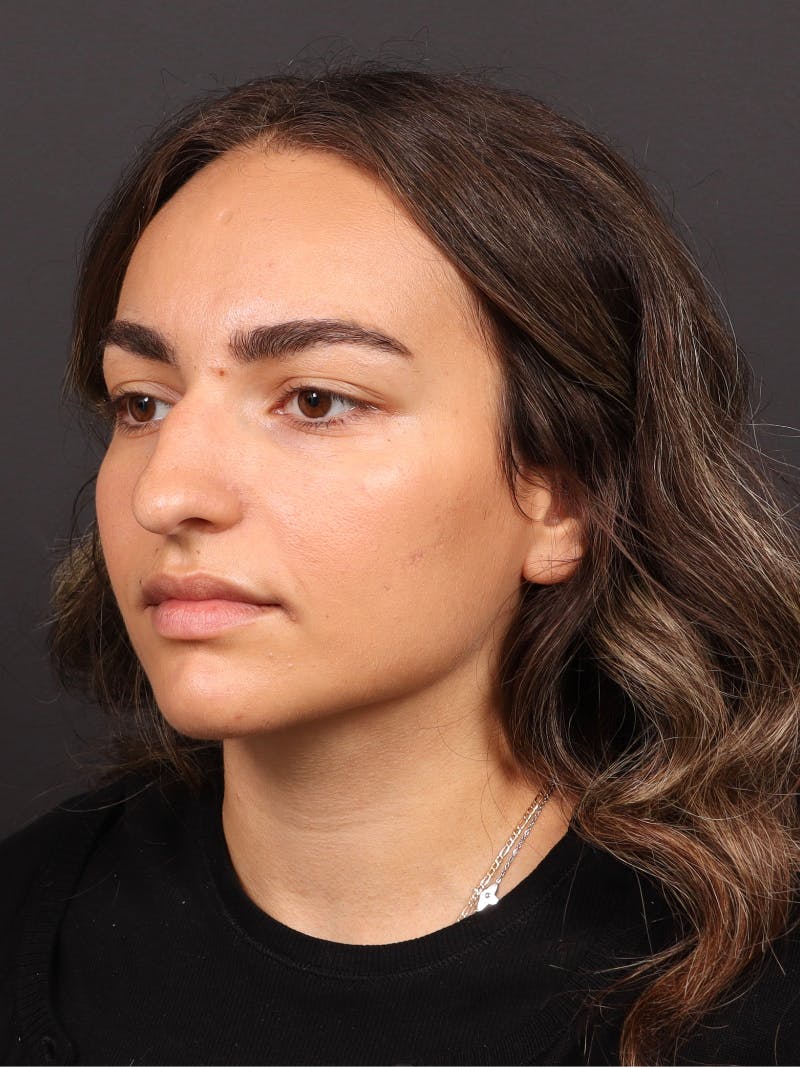 Primary Rhinoplasty Before & After Gallery - Patient 933905 - Image 7