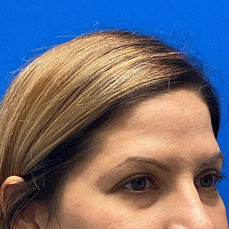Blepharoplasty Before & After Gallery - Patient 580254 - Image 3