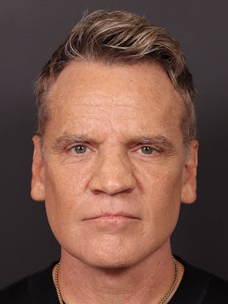 Blepharoplasty Before & After Gallery - Patient 322814 - Image 2