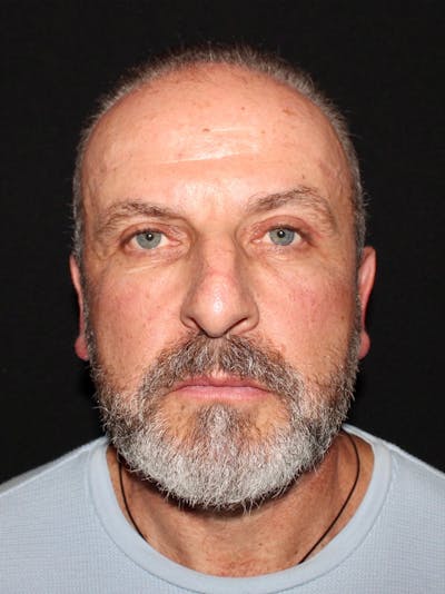 Blepharoplasty Before & After Gallery - Patient 669983 - Image 2