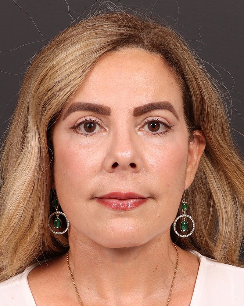 Facelift Before & After Gallery - Patient 161108 - Image 2