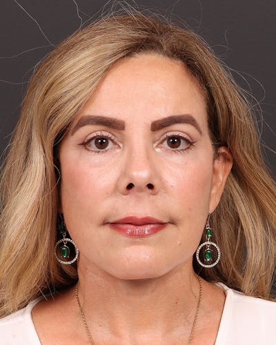 Facelift Before & After Gallery - Patient 161108 - Image 2