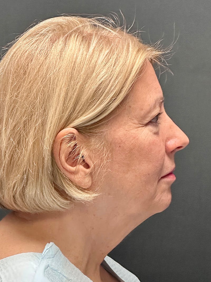Facelift Before & After Gallery - Patient 119611 - Image 5