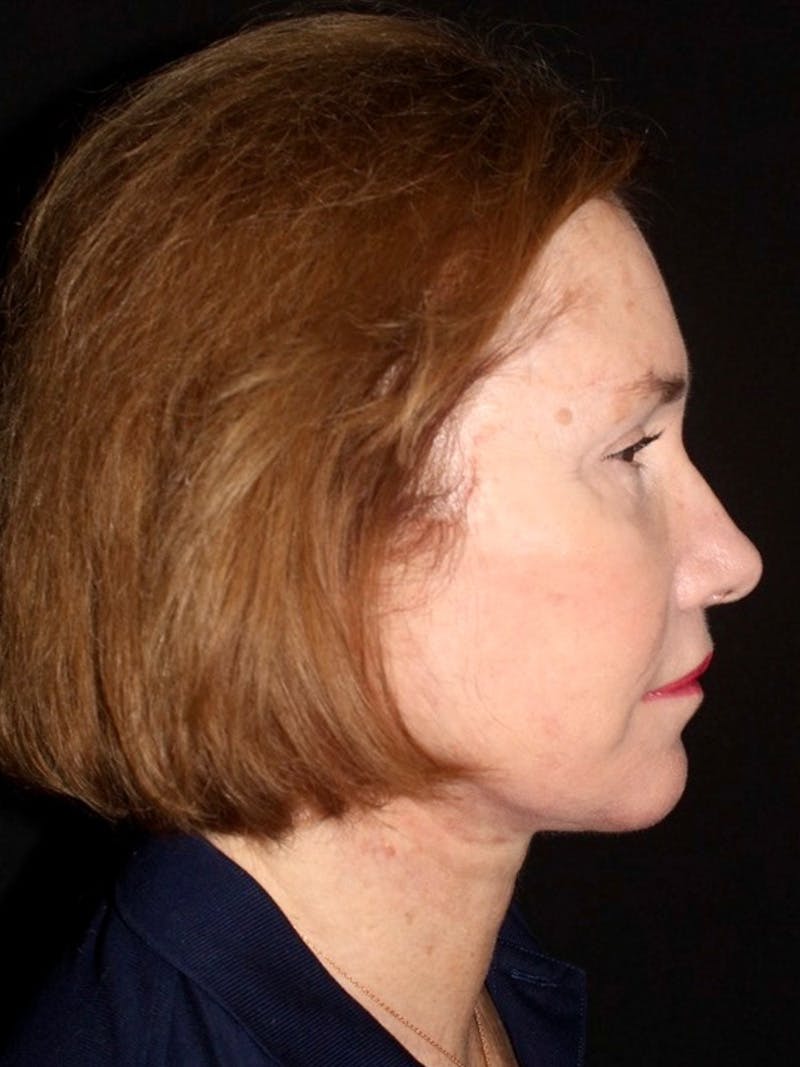 Facelift Before & After Gallery - Patient 349569 - Image 6