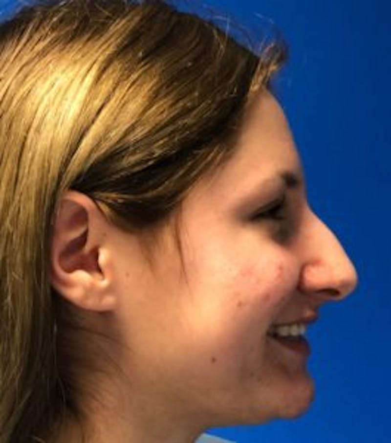 Primary Rhinoplasty Before & After Gallery - Patient 550195 - Image 9