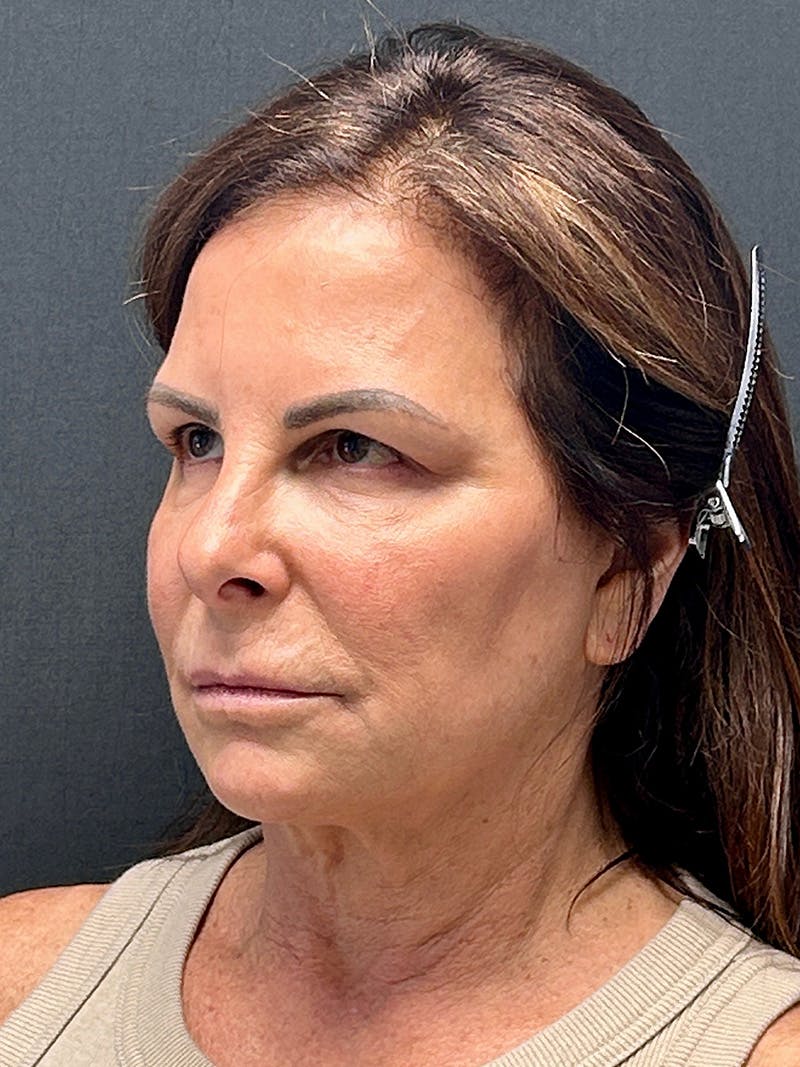 Brow Lift Before & After Gallery - Patient 349364 - Image 3