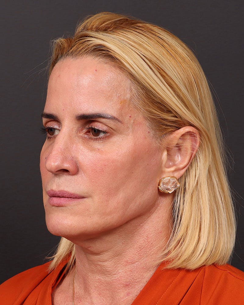 Facelift Before & After Gallery - Patient 965600 - Image 3