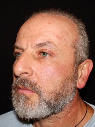 Blepharoplasty Before & After Gallery - Patient 669983 - Image 6