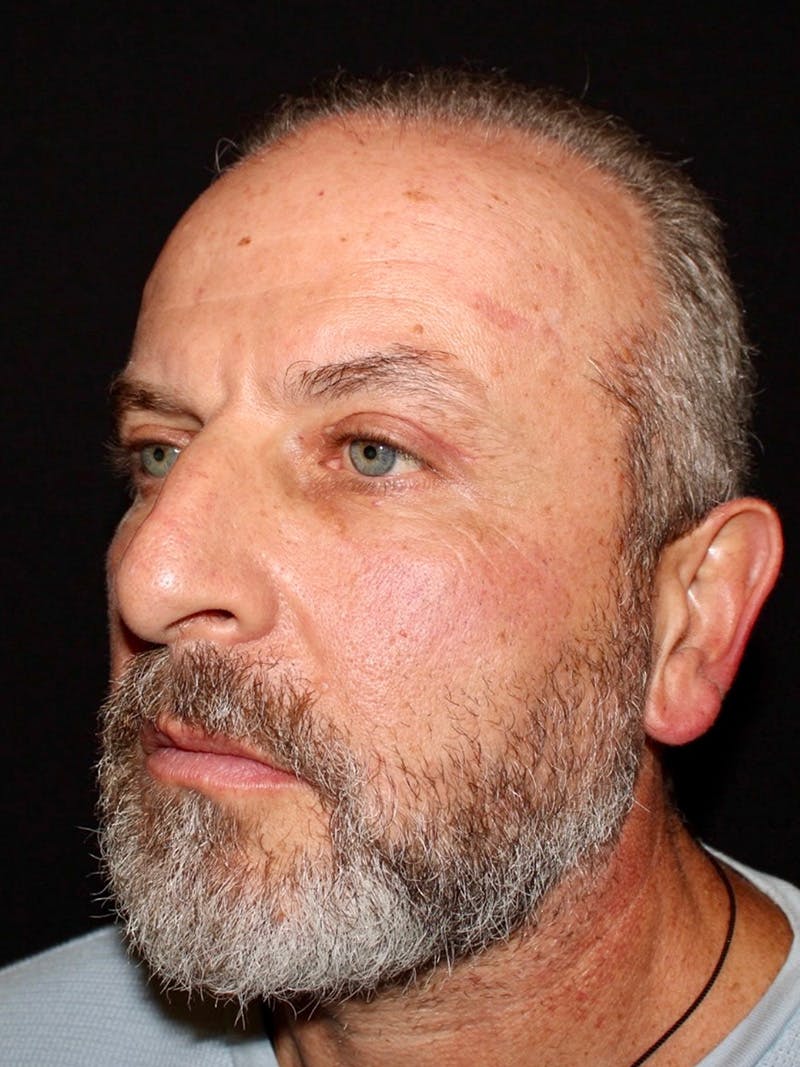 Blepharoplasty Before & After Gallery - Patient 669983 - Image 6