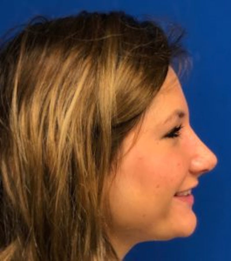 Primary Rhinoplasty Before & After Gallery - Patient 550195 - Image 10