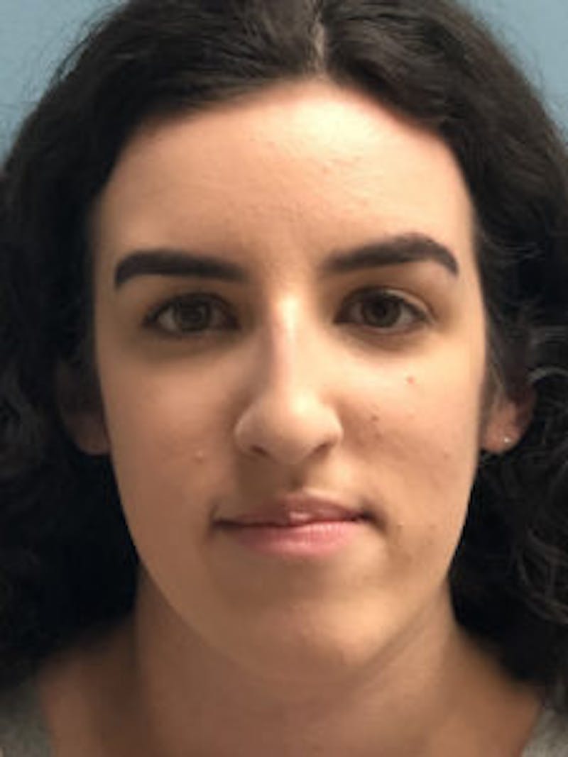 Primary Rhinoplasty Before & After Gallery - Patient 173090 - Image 3