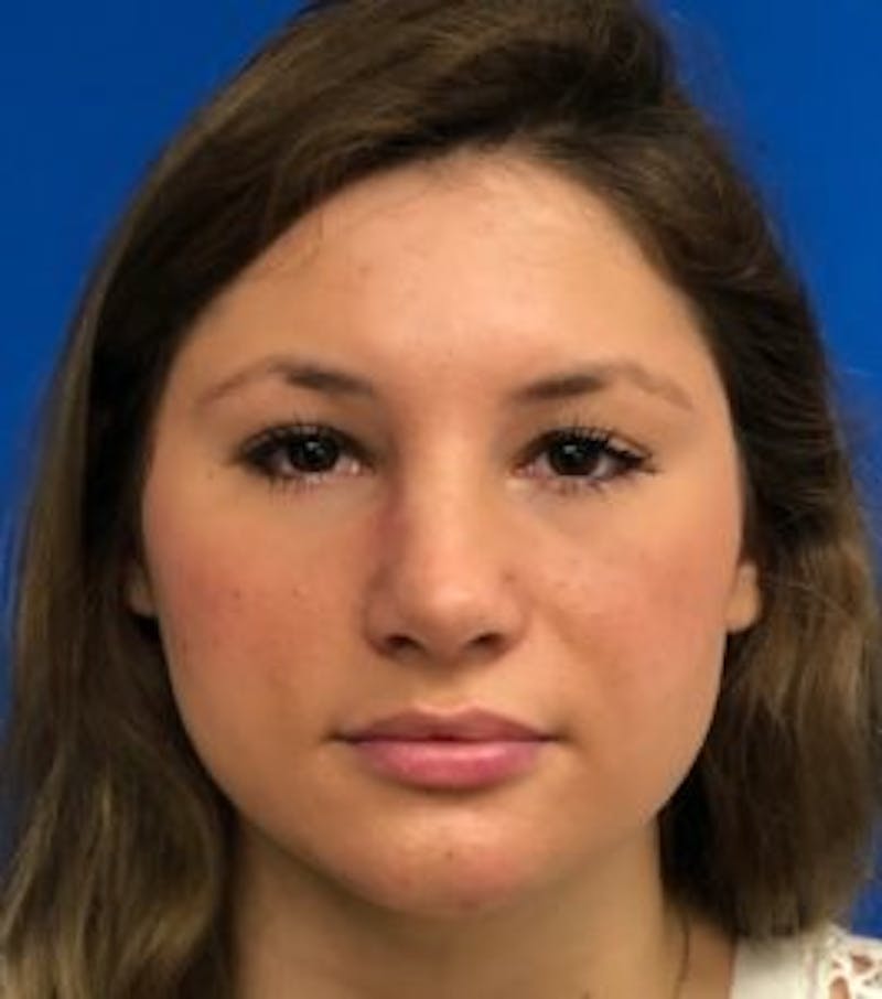 Primary Rhinoplasty Before & After Gallery - Patient 550195 - Image 6