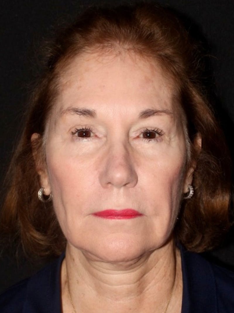 Facelift Before & After Gallery - Patient 349569 - Image 1