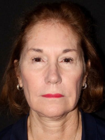 Facelift Before & After Gallery - Patient 349569 - Image 1