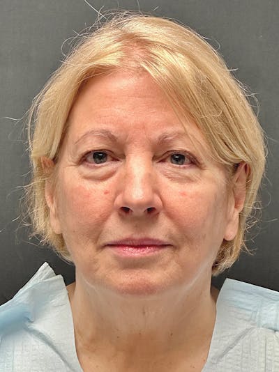 Facelift Before & After Gallery - Patient 119611 - Image 1