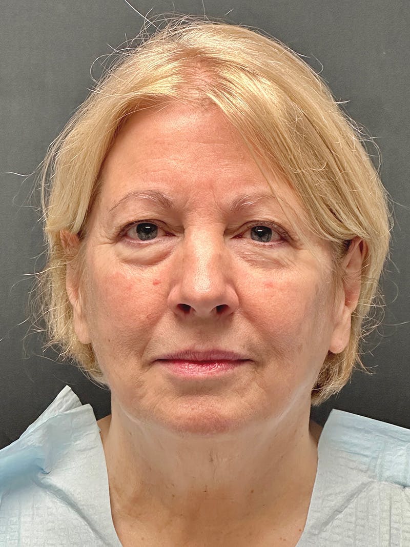 Facelift Before & After Gallery - Patient 119611 - Image 1