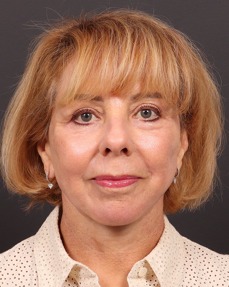 Facelift Before & After Gallery - Patient 304571 - Image 2