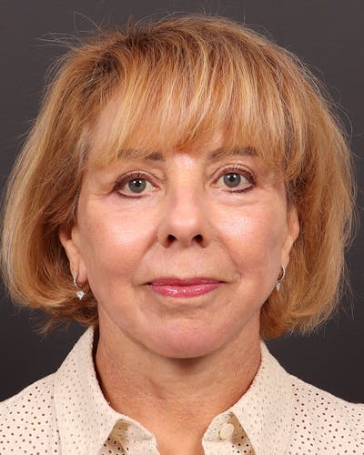 Facelift Before & After Gallery - Patient 304571 - Image 2