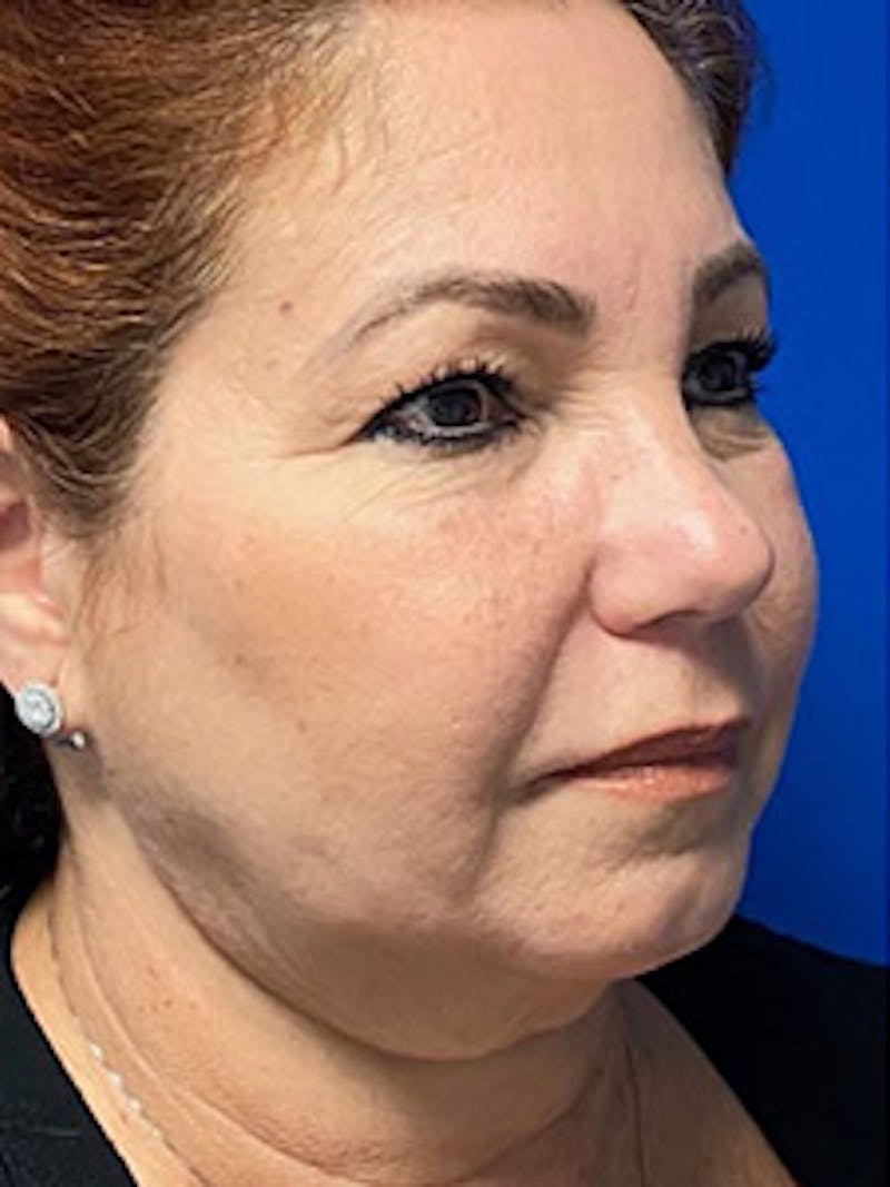 Facelift Before & After Gallery - Patient 287841 - Image 5