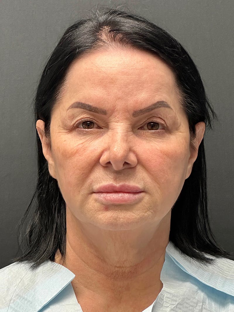 Blepharoplasty Before & After Gallery - Patient 409475 - Image 1