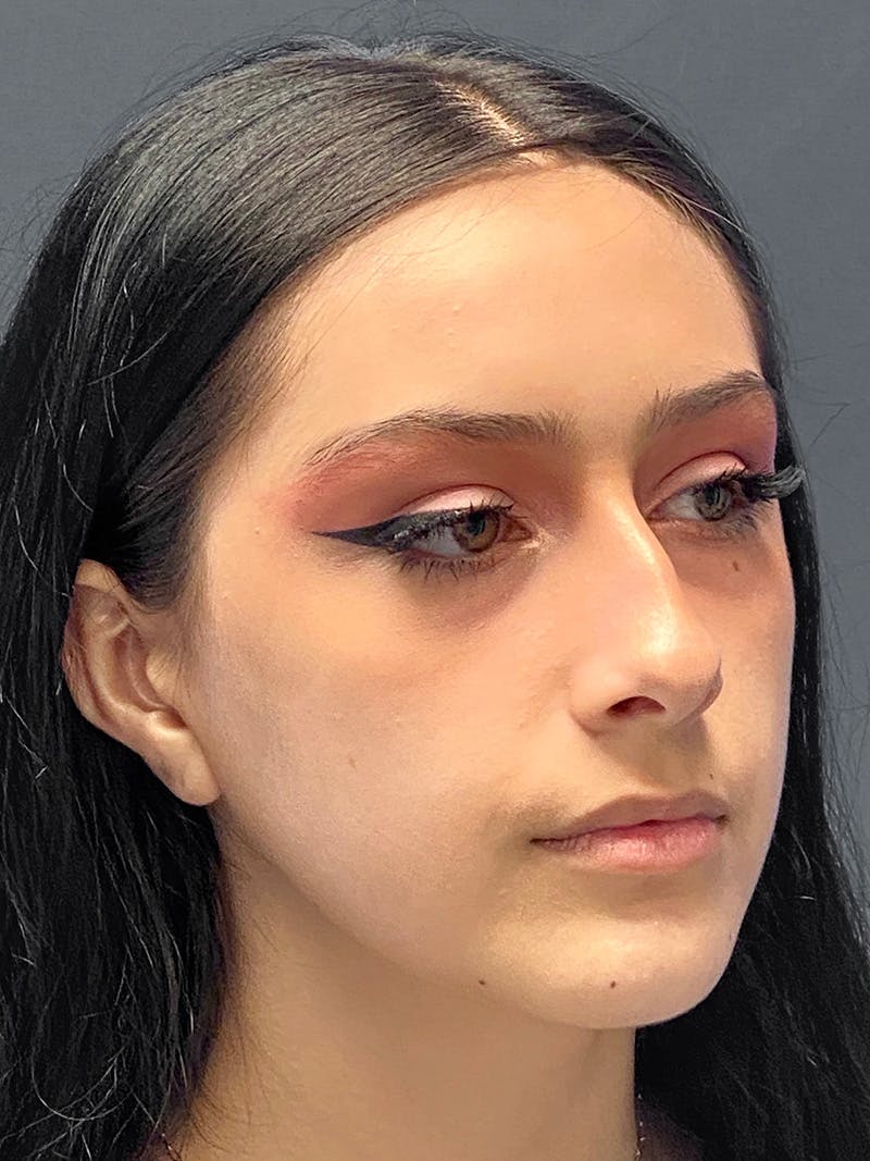 Primary Rhinoplasty Before & After Gallery - Patient 330004 - Image 5