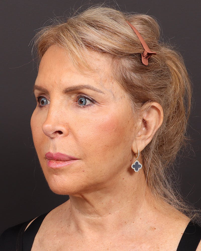 Facelift Before & After Gallery - Patient 402266 - Image 3
