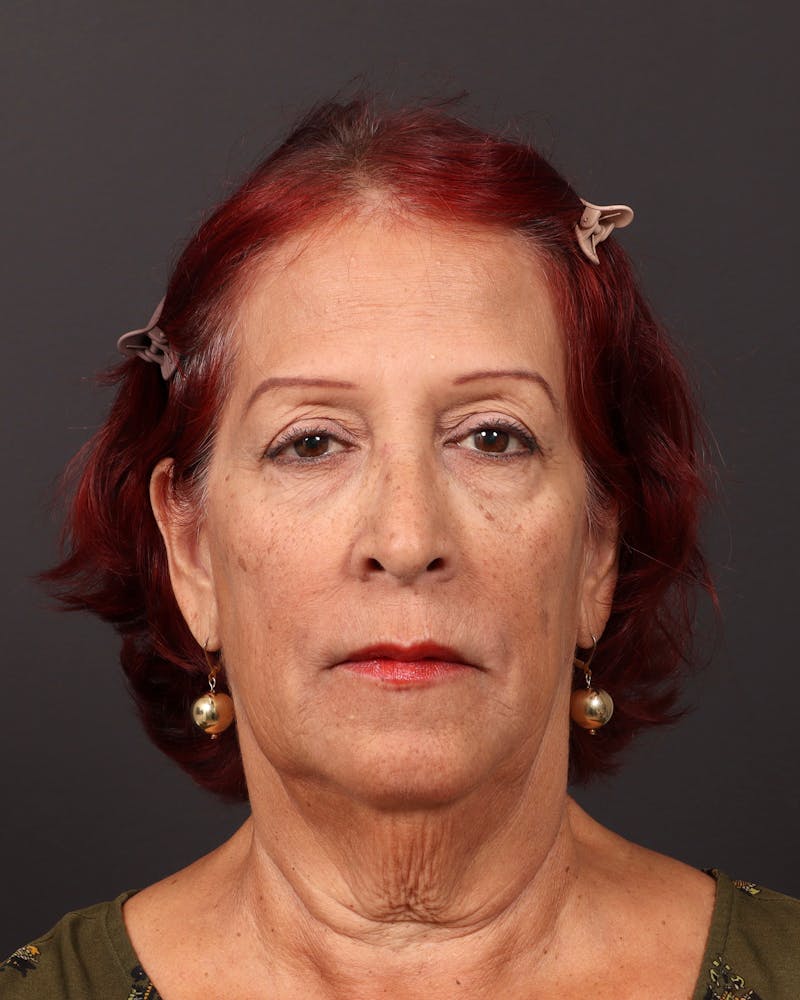 Facelift Before & After Gallery - Patient 171272 - Image 1
