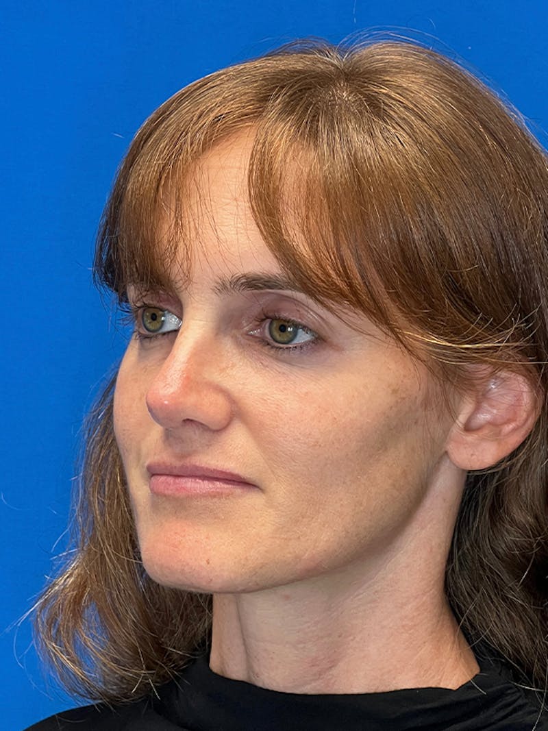 Revision Rhinoplasty Before & After Gallery - Patient 330413 - Image 6