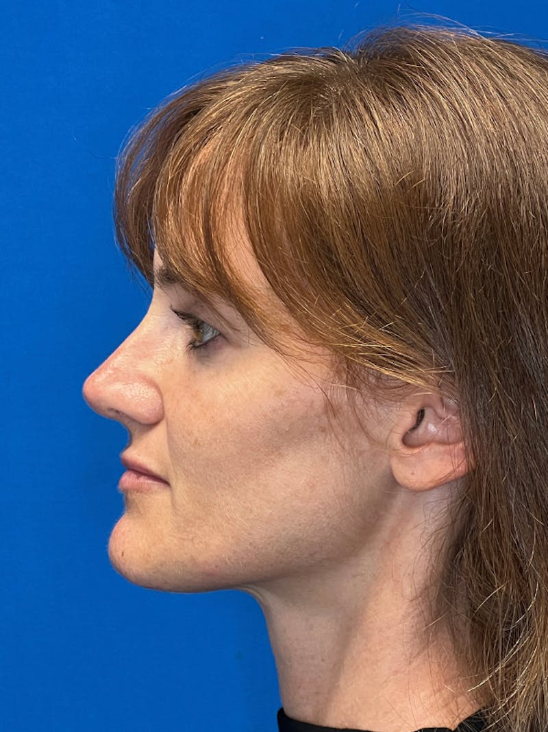 Revision Rhinoplasty Before & After Gallery - Patient 330413 - Image 2