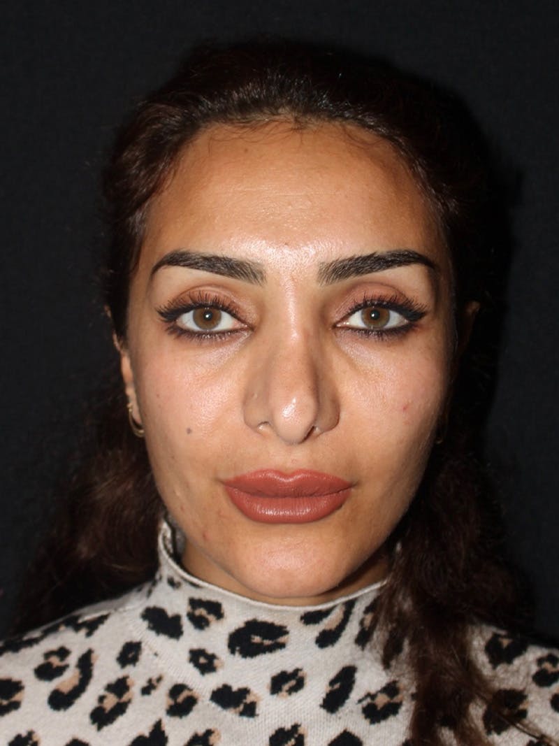 Revision Rhinoplasty Before & After Gallery - Patient 319821 - Image 3