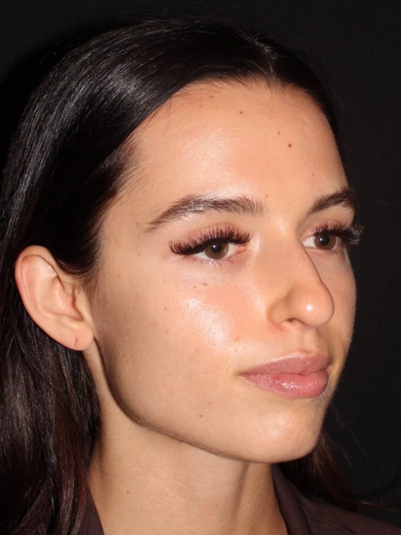 Primary Rhinoplasty Before & After Gallery - Patient 245621 - Image 5
