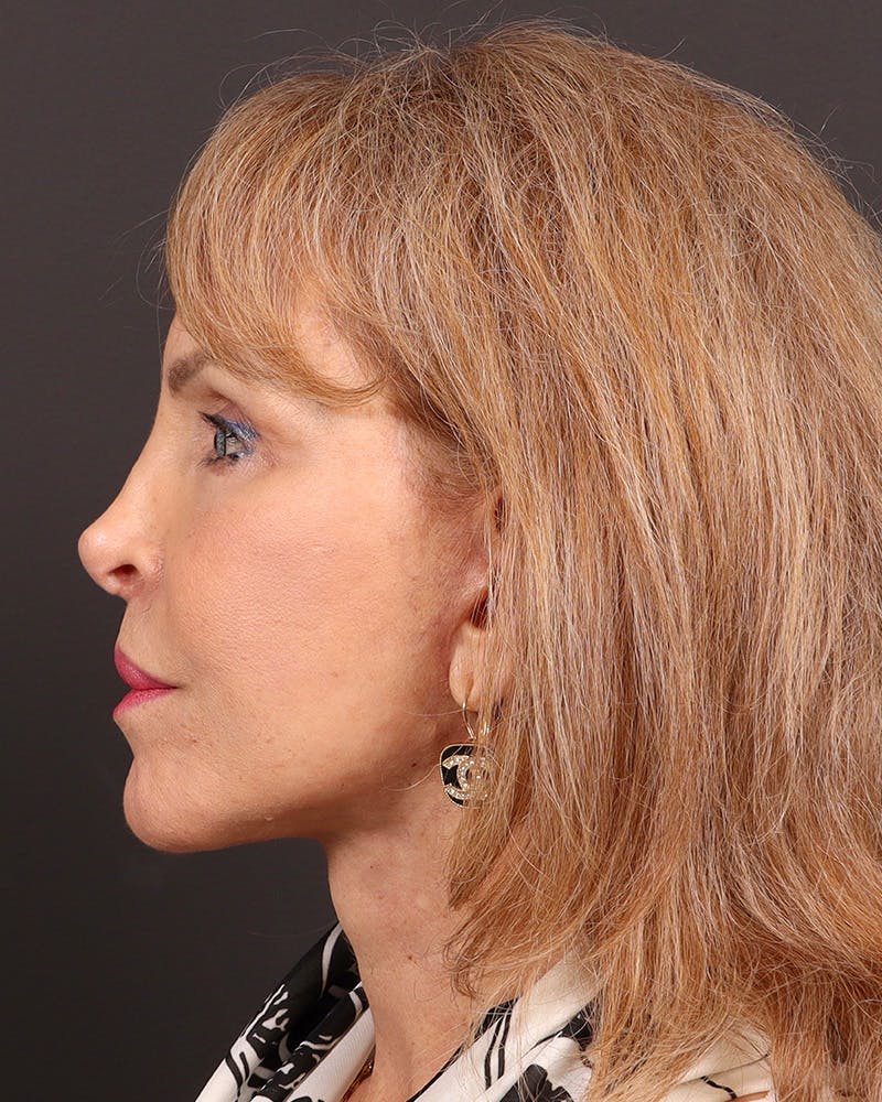 Facelift Before & After Gallery - Patient 402266 - Image 6