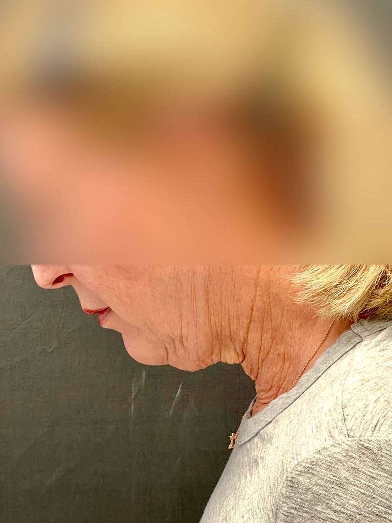 Facelift Before & After Gallery - Patient 355862 - Image 7