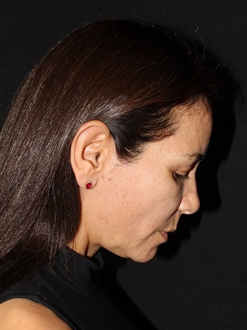 Facelift Before & After Gallery - Patient 899273 - Image 7
