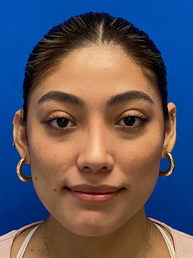 Primary Rhinoplasty Before & After Gallery - Patient 317021 - Image 4