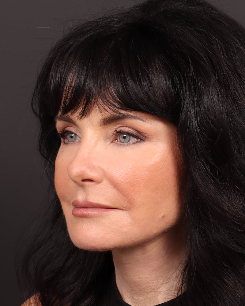 Facelift Before & After Gallery - Patient 285891 - Image 4