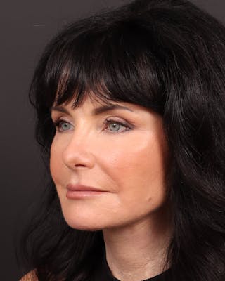 Facelift Before & After Gallery - Patient 285891 - Image 4