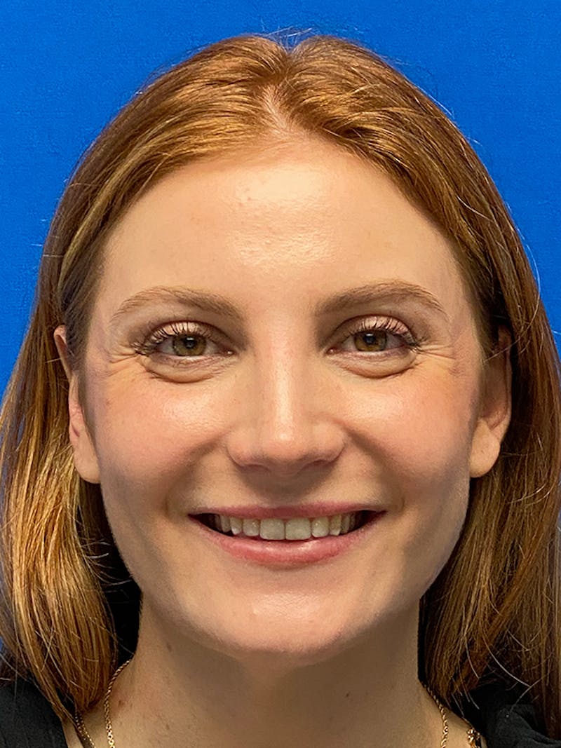Primary Rhinoplasty Before & After Gallery - Patient 202446 - Image 6
