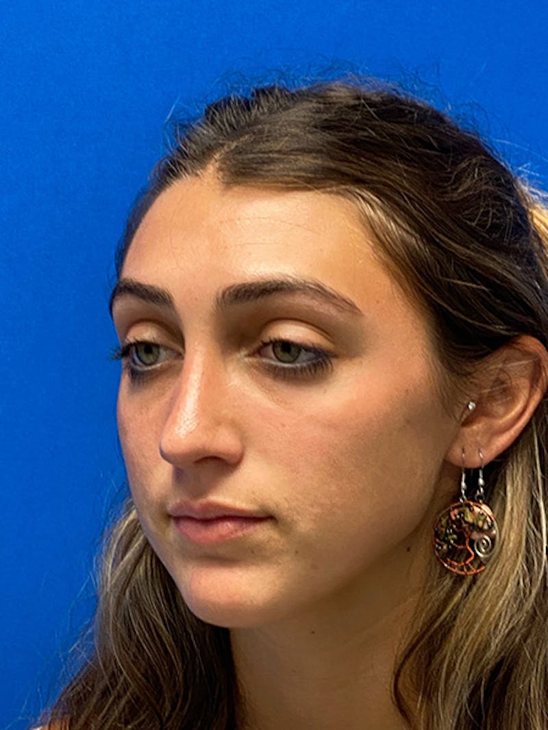 Primary Rhinoplasty Before & After Gallery - Patient 286346 - Image 8