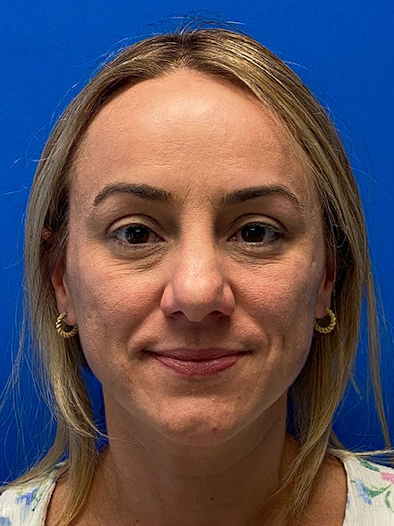Primary Rhinoplasty Before & After Gallery - Patient 784658 - Image 3