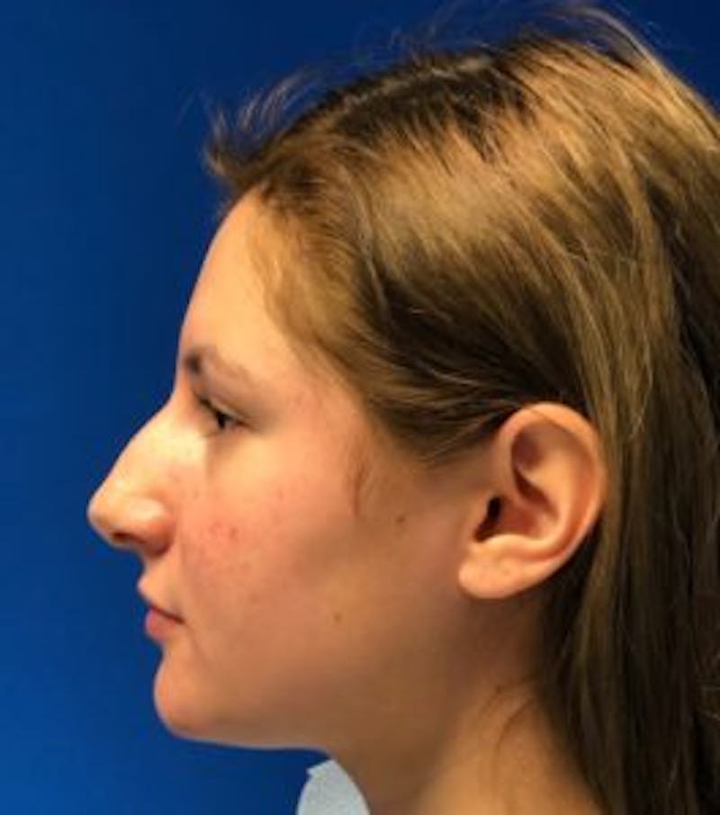 Primary Rhinoplasty Before & After Gallery - Patient 550195 - Image 11