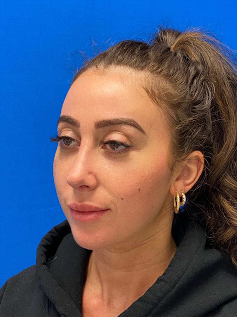 Primary Rhinoplasty Before & After Gallery - Patient 334537 - Image 8
