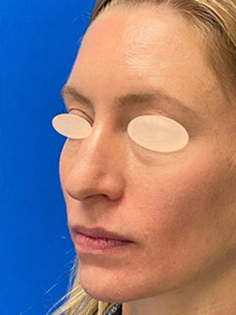 Primary Rhinoplasty Before & After Gallery - Patient 305892 - Image 5