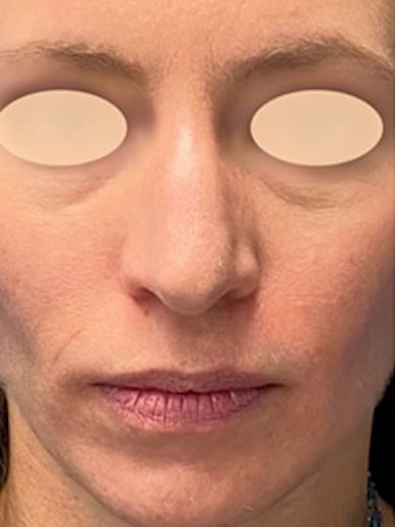 Primary Rhinoplasty Before & After Gallery - Patient 305892 - Image 3